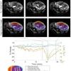 Uterine and placental changes during an example placental contraction. The top row shows axial MRI images at selected times points before, during and after a placental contraction (indicated by vertical lines on the graph below) with segmentations shown below. Changes in placental and non-placental volumes, wall areas and placental R2* (all measured across the whole volume of the uterus, not just the single slice shown) are plotted underneath. The legend indicates the colors used for the lines in the plots and the regions indicated in the segmentation.