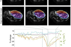 Uterine and placental changes during an example placental contraction. The top row shows axial MRI images at selected times points before, during and after a placental contraction (indicated by vertical lines on the graph below) with segmentations shown below. Changes in placental and non-placental volumes, wall areas and placental R2* (all measured across the whole volume of the uterus, not just the single slice shown) are plotted underneath. The legend indicates the colors used for the lines in the plots and the regions indicated in the segmentation.