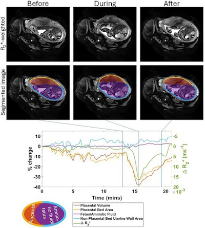 Uterine and placental changes during an example placental contraction. The top row shows axial MRI images at selected times points before, during and after a placental contraction (indicated by vertical lines on the graph below) with segmentations shown below. Changes in placental and non-placental volumes, wall areas and placental R2* (all measured across the whole volume of the uterus, not just the single slice shown) are plotted underneath. The legend indicates the colors used for the lines in the plots and the regions indicated in the segmentation.