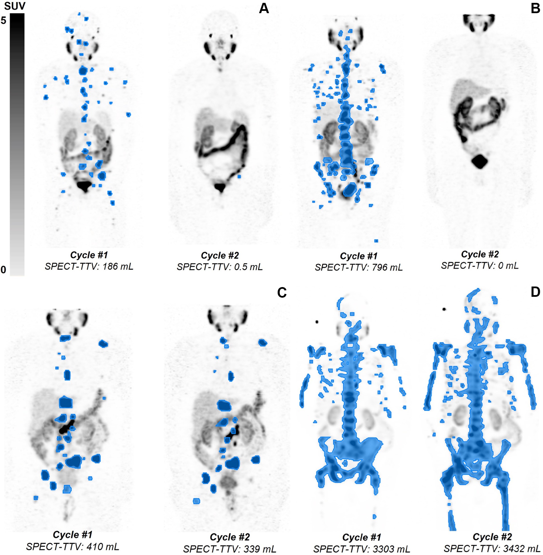 Quantification of total tumor volume (TTV) at lutetium-177 prostate-specific membrane antigen (PSMA)&ndash;617 SPECT/CT shows heterogeneous TTV responses between dose 1 (Cycle #1) and dose 2 (Cycle #2) in participants with metastatic castration-resistant prostate cancer. Posttherapy coronal attenuation-corrected noncontrast SPECT/CT maximum intensity projection images demonstrate (A) near-complete response in a 76-year-old man, (B) complete response in an 83-year-old man, (C) partial TTV reduction (not complete response) in a 69-year-old man, and (D) TTV increase (i.e. progressive disease) in a 74-year-old man. Blue-shaded regions represent semiautomatically segmented PSMA-avid tumor volume, with associated TTV values given at the bottom of each panel. The gradient bar shows standardized uptake value (SUV) from 0 to 5.
