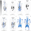 Quantification of total tumor volume (TTV) at lutetium-177 prostate-specific membrane antigen (PSMA)–617 SPECT/CT shows heterogeneous TTV responses between dose 1 (Cycle #1) and dose 2 (Cycle #2) in participants with metastatic castration-resistant prostate cancer. Posttherapy coronal attenuation-corrected noncontrast SPECT/CT maximum intensity projection images demonstrate (A) near-complete response in a 76-year-old man, (B) complete response in an 83-year-old man, (C) partial TTV reduction (not complete response) in a 69-year-old man, and (D) TTV increase (i.e. progressive disease) in a 74-year-old man. Blue-shaded regions represent semiautomatically segmented PSMA-avid tumor volume, with associated TTV values given at the bottom of each panel. The gradient bar shows standardized uptake value (SUV) from 0 to 5.
