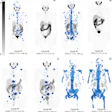 Quantification of total tumor volume (TTV) at lutetium-177 prostate-specific membrane antigen (PSMA)–617 SPECT/CT shows heterogeneous TTV responses between dose 1 (Cycle #1) and dose 2 (Cycle #2) in participants with metastatic castration-resistant prostate cancer. Posttherapy coronal attenuation-corrected noncontrast SPECT/CT maximum intensity projection images demonstrate (A) near-complete response in a 76-year-old man, (B) complete response in an 83-year-old man, (C) partial TTV reduction (not complete response) in a 69-year-old man, and (D) TTV increase (i.e. progressive disease) in a 74-year-old man. Blue-shaded regions represent semiautomatically segmented PSMA-avid tumor volume, with associated TTV values given at the bottom of each panel. The gradient bar shows standardized uptake value (SUV) from 0 to 5.