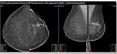 80-year-old patient with history of breast cancer had a mass in the operated breast as shown here on mammography and tomosynthesis. Ultrasound found lesions in both breasts and these were deemed BIRADS 4C. Patient was biopsied without markers.
