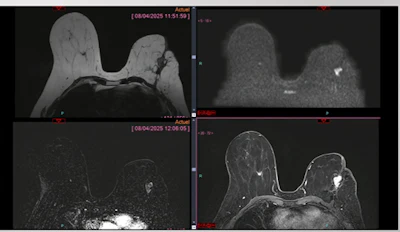 After biopsy, and findings of adenofibroma (r) and fusiform and inflammatory cells (l), MRI sequences showed suspicious lesions, and a second biopsy revealed invasive ductal carcinoma in the left breast.