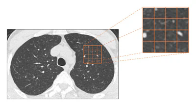 An explanatory schematization of the quantitative CT (histogram analysis) method.