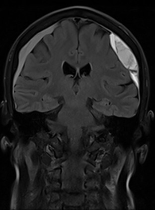 71-year-old patient with headaches and unsteady gait. Coronal MRI before embolization demonstrating a chronic subdural hematoma (cSDH).