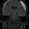 71-year-old patient with headaches and unsteady gait. Coronal MRI before embolization demonstrating a chronic subdural hematoma (cSDH).