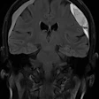 71-year-old patient with headaches and unsteady gait. Coronal MRI before embolization demonstrating a chronic subdural hematoma (cSDH).