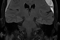 71-year-old patient with headaches and unsteady gait. Coronal MRI before embolization demonstrating a chronic subdural hematoma (cSDH).