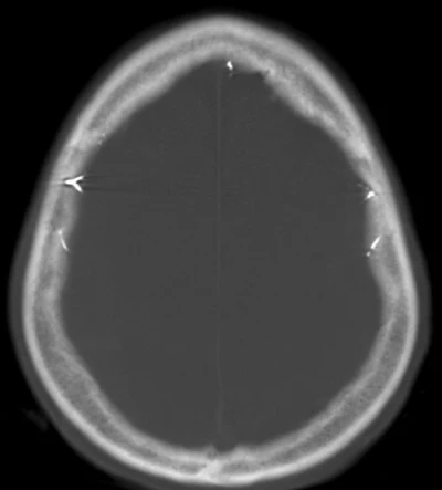 71-year-old patient with headaches and unsteady gait. Flat-detector CT (FDCT) after embolization showing the administered embolic agent.