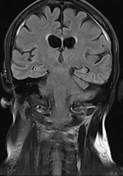 71-year-old patient with headaches and unsteady gait. Follow-up MRI three months after embolization showing marked regression of the hematoma; the patient is clinically symptom-free.