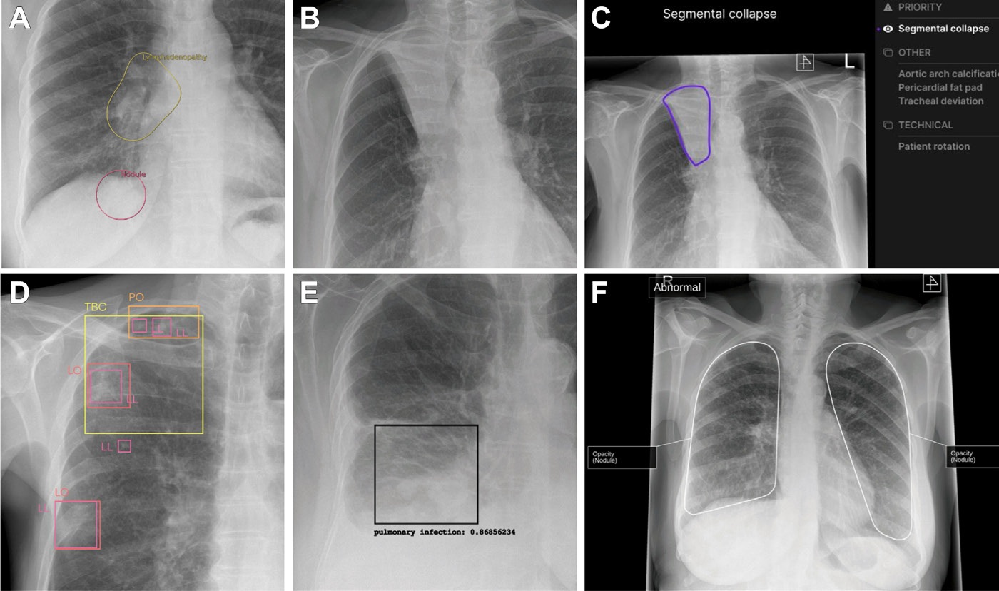 Cropped secondary capture examples. These are illustrative and not intended to imply superiority or inferiority of any device. (A) Posteroanterior radiograph in a 46-year-old female patient. The device correctly identified a right lower lobe nodule projected below the right hemidiaphragm and hilar lymphadenopathy. (B) Posteroanterior radiograph in an 86-year-old female patient with a classic Golden S sign highly suggestive of cancer. Three devices did not identify any findings. (C) The output from one device for the same radiograph as in B. The device placed a contour around the area of abnormality but mislabeled it as segmental collapse, and there are no other elements in the output to raise suspicion of cancer. (D) Posteroanterior radiograph in a 60-year-old male patient -- a case of confirmed lung cancer that was not deemed visible in retrospect. The device identified multiple false-positive abnormalities. (E) Posteroanterior radiograph in a 77-year-old female patient with two right lower lobe nodules. The device mislabeled the abnormality as infection -- a diagnostic term that could incorrectly influence clinical management. (F) Posteroanterior radiograph in a 77-year-old female patient with a right hilar tumor. Most of the lungs have been labeled by the device, with excessive overlap of the abnormality that pragmatically represents an incorrect result. All annotations shown were produced by the devices. LL = lung lesion, LO = lung opacity, PO = pleural other, TBC = tuberculosis.