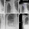 Cropped secondary capture examples. These are illustrative and not intended to imply superiority or inferiority of any device. (A) Posteroanterior radiograph in a 46-year-old female patient. The device correctly identified a right lower lobe nodule projected below the right hemidiaphragm and hilar lymphadenopathy. (B) Posteroanterior radiograph in an 86-year-old female patient with a classic Golden S sign highly suggestive of cancer. Three devices did not identify any findings. (C) The output from one device for the same radiograph as in B. The device placed a contour around the area of abnormality but mislabeled it as segmental collapse, and there are no other elements in the output to raise suspicion of cancer. (D) Posteroanterior radiograph in a 60-year-old male patient -- a case of confirmed lung cancer that was not deemed visible in retrospect. The device identified multiple false-positive abnormalities. (E) Posteroanterior radiograph in a 77-year-old female patient with two right lower lobe nodules. The device mislabeled the abnormality as infection -- a diagnostic term that could incorrectly influence clinical management. (F) Posteroanterior radiograph in a 77-year-old female patient with a right hilar tumor. Most of the lungs have been labeled by the device, with excessive overlap of the abnormality that pragmatically represents an incorrect result. All annotations shown were produced by the devices. LL = lung lesion, LO = lung opacity, PO = pleural other, TBC = tuberculosis.