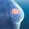Breast Cancer3