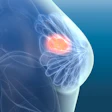 Breast Cancer3