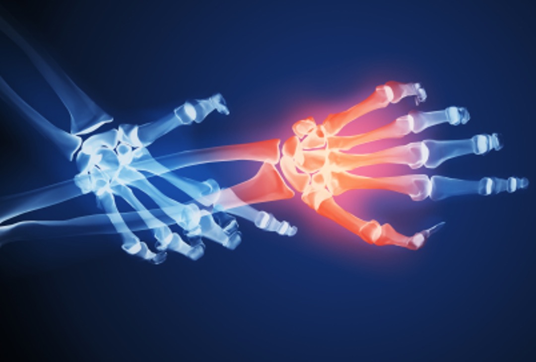 Hand Xrays