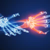 Hand Xrays