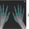 Overlap between manual (radiologist) and semiautomatic (algorithm) segmentations of hand joints on a standard posteroanterior radiograph. Orange overlay indicates manual radiologist segmentations, blue overlay shows algorithm segmentations, and green overlay indicates consistent regions between both methods.