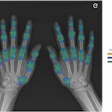 Overlap between manual (radiologist) and semiautomatic (algorithm) segmentations of hand joints on a standard posteroanterior radiograph. Orange overlay indicates manual radiologist segmentations, blue overlay shows algorithm segmentations, and green overlay indicates consistent regions between both methods.