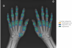 Overlap between manual (radiologist) and semiautomatic (algorithm) segmentations of hand joints on a standard posteroanterior radiograph. Orange overlay indicates manual radiologist segmentations, blue overlay shows algorithm segmentations, and green overlay indicates consistent regions between both methods.