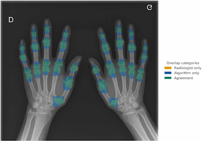 Overlap between manual (radiologist) and semiautomatic (algorithm) segmentations of hand joints on a standard posteroanterior radiograph. Orange overlay indicates manual radiologist segmentations, blue overlay shows algorithm segmentations, and green overlay indicates consistent regions between both methods.