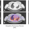 Sample images from each participant group: A: CT only; B: fused Tc-99m maraciclatide SPECT/CT.
