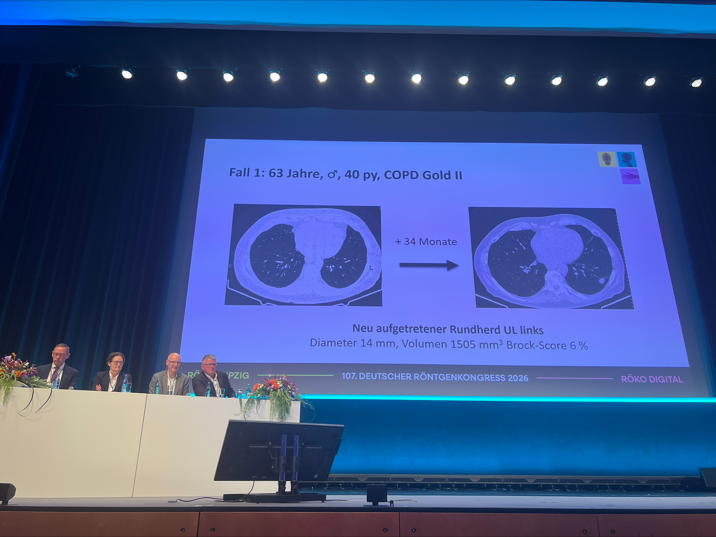 Early-stage findings are not always straightforward, and multidisciplinary judgment is not a formality, the nodule conference at the close of the highlight session 'Us against lung cancer' made that clear. R&ouml;Ko 2026, Leipzig.