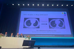 Early-stage findings are not always straightforward, and multidisciplinary judgment is not a formality, the nodule conference at the close of the highlight session 'Us against lung cancer' made that clear. RöKo 2026, Leipzig.