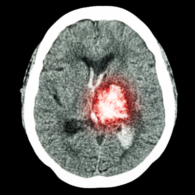 Mri Brain Disease4 400