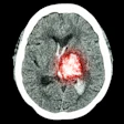 Mri Brain Disease4 400