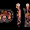 Pet Ct Scan Fusion Image