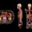 Pet Ct Scan Fusion Image