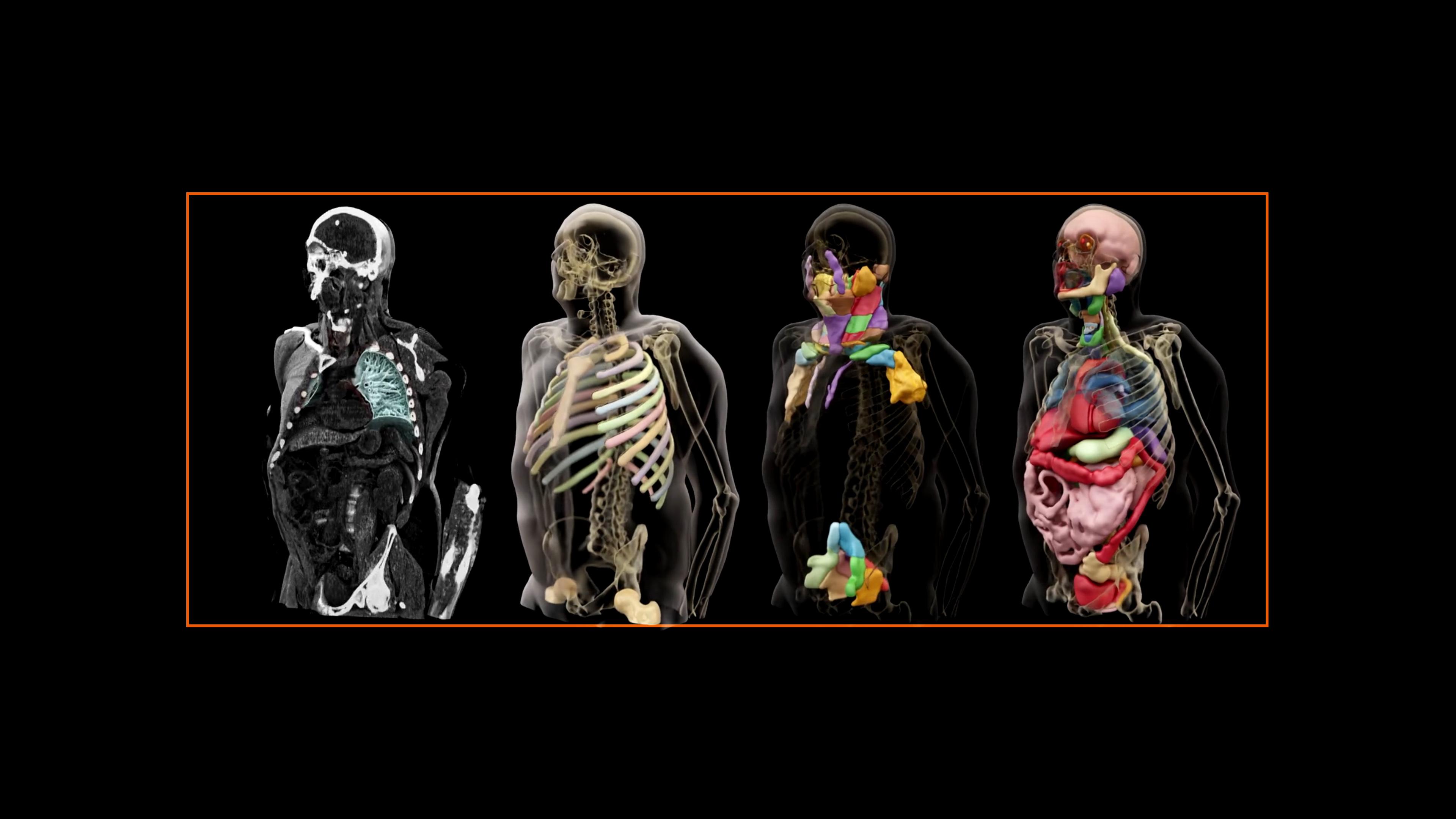 Siemens Healthineers Press Ai Contouring