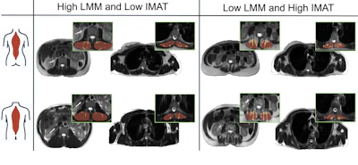 Exemplary cases across four intermuscular adipose tissue (IMAT)–lean muscle mass (LMM) z score combinations. The figure shows four LMM-IMAT combinations in women (top row) and men (bottom row). From right to left, the panels show axial T2-weighted half-Fourier acquisition single-shot turbo spin-echo images of the thoracic and lumbar regions in individuals with high LMM and low IMAT and with low LMM and high IMAT. Participants were randomly selected from the highest or lowest quartile of each respective LMM-IMAT combination and were of similar age (44 years ± 2 [SD]) and body mass index in weight in kilograms divided by height in meters squared (21 ± 2). Segmentation masks for intermuscular fat and lean muscle are displayed in the top right corner of each region.