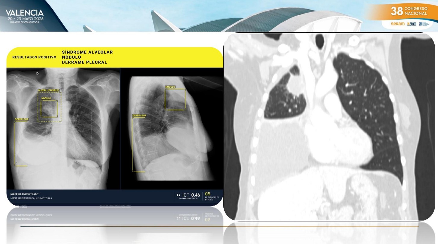 An AI system highlights multiple abnormalities on a chest radiograph, including a pulmonary nodule (n&oacute;dulo pulmonar), pleural effusion (derrame pleural), and alveolar syndrome/consolidation (s&iacute;ndrome alveolar).