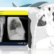 An AI system highlights multiple abnormalities on a chest radiograph, including a pulmonary nodule (nódulo pulmonar), pleural effusion (derrame pleural), and alveolar syndrome/consolidation (síndrome alveolar).
