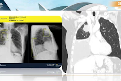 An AI system highlights multiple abnormalities on a chest radiograph, including a pulmonary nodule (nódulo pulmonar), pleural effusion (derrame pleural), and alveolar syndrome/consolidation (síndrome alveolar).