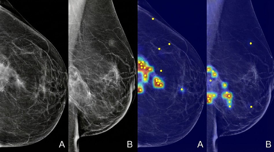Grad-CAM heatmaps showing the AI model's areas of attention overlaid on standard mammography views, as displayed to radiologists during the XAI-assisted reading sessions.