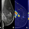 Grad-CAM heatmaps showing the AI model's areas of attention overlaid on standard mammography views, as displayed to radiologists during the XAI-assisted reading sessions.