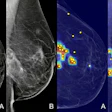 Grad-CAM heatmaps showing the AI model's areas of attention overlaid on standard mammography views, as displayed to radiologists during the XAI-assisted reading sessions.