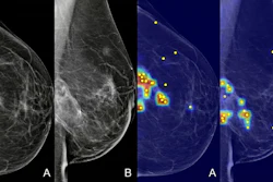 Grad-CAM heatmaps showing the AI model's areas of attention overlaid on standard mammography views, as displayed to radiologists during the XAI-assisted reading sessions.