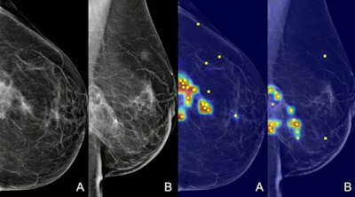 Grad-CAM heatmaps showing the AI model's areas of attention overlaid on standard mammography views, as displayed to radiologists during the XAI-assisted reading sessions.