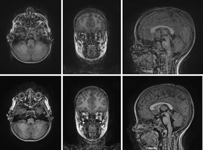 Movement during an MRI examination can significantly impair image quality (top). Through suitable preparation measures and modern examination techniques, diagnostically high-quality images are intended to be achieved without anesthesia as well (bottom).