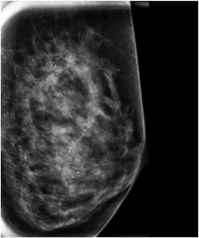 Mammogram with grouped heterogeneous microcalcifications showing linear distribution attributable to atypical ductal hyperplasia.