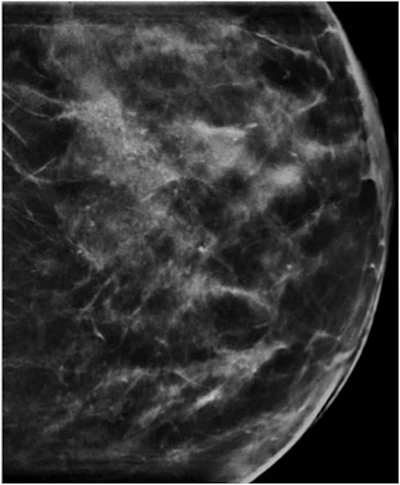 Amorphous microcalcifications with a segmental distribution typical of lobular neoplasia.