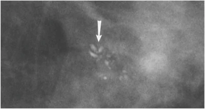 Grouped coarse heterogeneous microcalcifications.