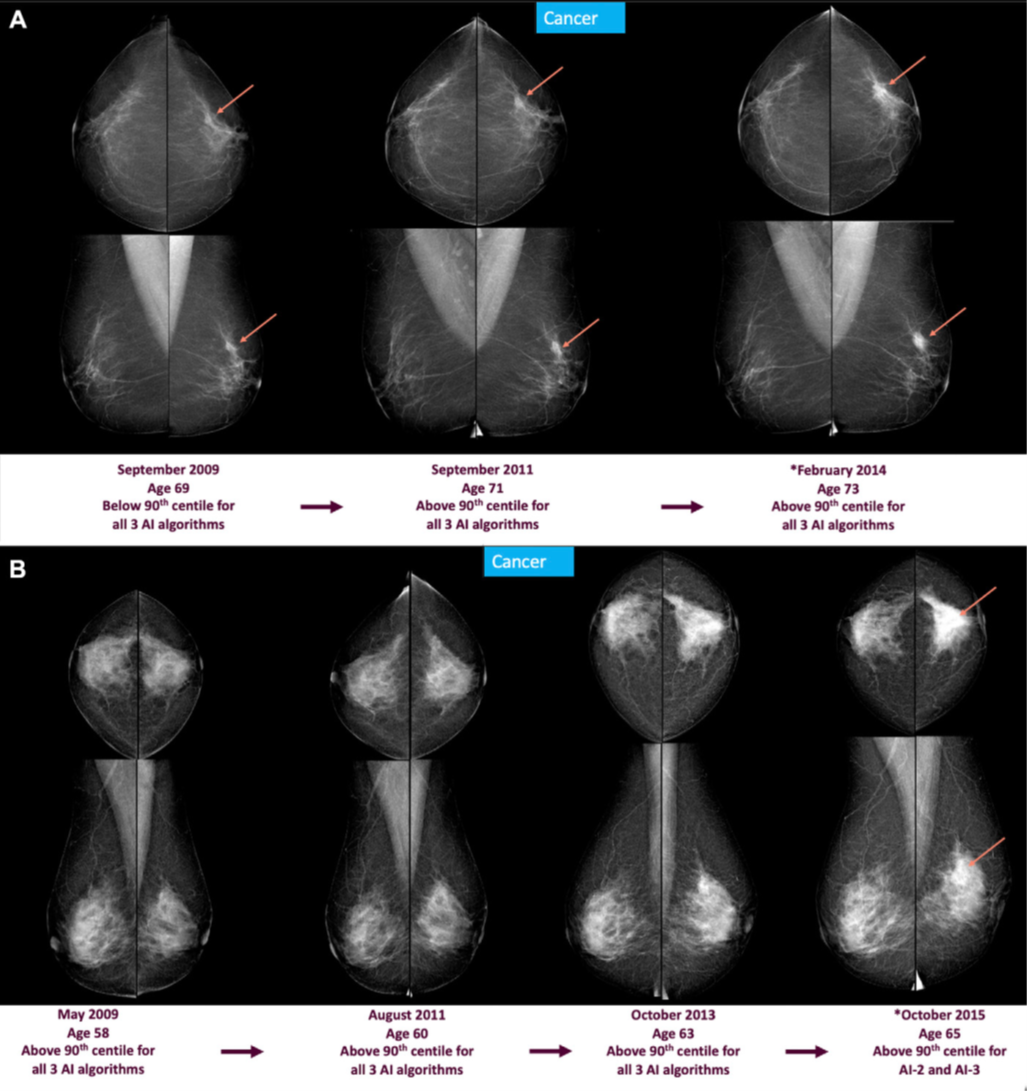 Screening mammograms and AI score changes are depicted over time in two individuals with screen-detected cancer. Full-field digital mammograms show craniocaudal (top) and mediolateral (bottom) views of the left and right breast. The description below each mammogram indicates whether AI scores from three AI-based computer-aided detection systems (AI-1, AI-2, and AI-3) were above or below the 90th percentile. (A) Mammograms from three screening time points (in 2009, 2011, and 2014) in an individual who was diagnosed in February 2014 (at age 73 years) with a left-sided 25-mm grade 2 invasive breast carcinoma, no special type (arrow). Mammographic breast density was classified as BI-RADS B on all three mammograms. (B) Mammograms from four screening time points (in 2009, 2011, 2013, and 2015) in an individual who was diagnosed in October 2015 (at age 65 years) with a left-sided 45-mm grade 2 lobular carcinoma (arrow). Mammographic breast density was classified as BI-RADS C on all four mammograms. Screen-detected cancers were defined as those diagnosed within 90 days for individuals who were recalled at screening (*).