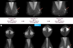 Screening mammograms and AI score changes are depicted over time in two individuals with screen-detected cancer. Full-field digital mammograms show craniocaudal (top) and mediolateral (bottom) views of the left and right breast. The description below each mammogram indicates whether AI scores from three AI-based computer-aided detection systems (AI-1, AI-2, and AI-3) were above or below the 90th percentile. (A) Mammograms from three screening time points (in 2009, 2011, and 2014) in an individual who was diagnosed in February 2014 (at age 73 years) with a left-sided 25-mm grade 2 invasive breast carcinoma, no special type (arrow). Mammographic breast density was classified as BI-RADS B on all three mammograms. (B) Mammograms from four screening time points (in 2009, 2011, 2013, and 2015) in an individual who was diagnosed in October 2015 (at age 65 years) with a left-sided 45-mm grade 2 lobular carcinoma (arrow). Mammographic breast density was classified as BI-RADS C on all four mammograms. Screen-detected cancers were defined as those diagnosed within 90 days for individuals who were recalled at screening (*).
