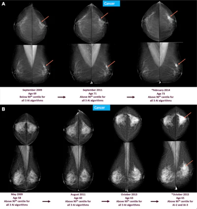 Screening mammograms and AI score changes are depicted over time in two individuals with screen-detected cancer. Full-field digital mammograms show craniocaudal (top) and mediolateral (bottom) views of the left and right breast. The description below each mammogram indicates whether AI scores from three AI-based computer-aided detection systems (AI-1, AI-2, and AI-3) were above or below the 90th percentile. (A) Mammograms from three screening time points (in 2009, 2011, and 2014) in an individual who was diagnosed in February 2014 (at age 73 years) with a left-sided 25-mm grade 2 invasive breast carcinoma, no special type (arrow). Mammographic breast density was classified as BI-RADS B on all three mammograms. (B) Mammograms from four screening time points (in 2009, 2011, 2013, and 2015) in an individual who was diagnosed in October 2015 (at age 65 years) with a left-sided 45-mm grade 2 lobular carcinoma (arrow). Mammographic breast density was classified as BI-RADS C on all four mammograms. Screen-detected cancers were defined as those diagnosed within 90 days for individuals who were recalled at screening (*).