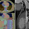An example of machine learning–based multiorgan body composition assessment (TotalSegmentator V2.0.4, 1.5-mm high-resolution model) in a 63-year-old man with obstructive coronary artery disease and a skeletal muscle attenuation below the median. (A) Transverse, (B) coronal, and (C) sagittal CT images and curved planar reformations of the (D) left, (E) circumflex, and (F) right coronary arteries.